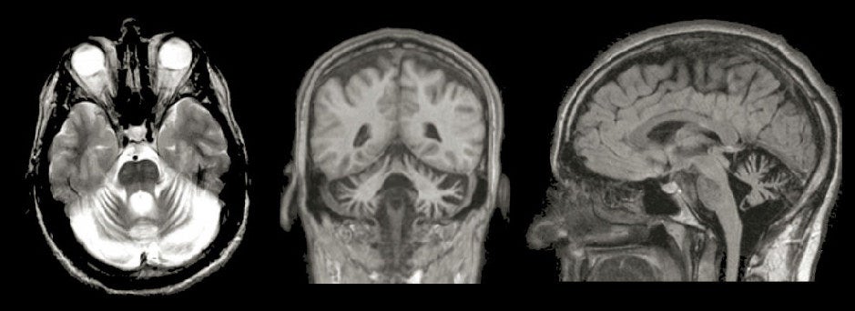 Cerebellar Degeneration